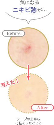 ニキビ跡からメイク 利用前利用後
